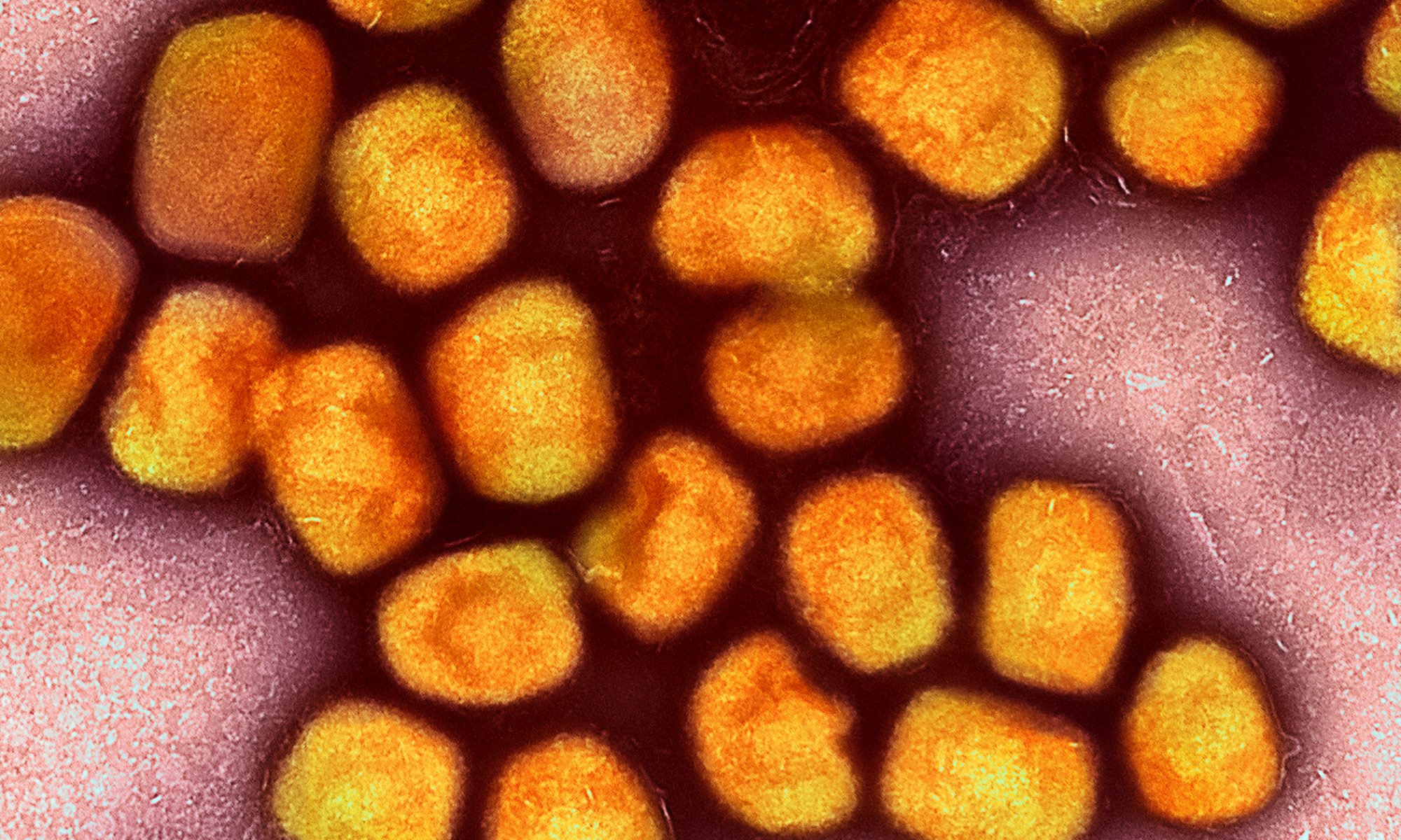 Monkeypox Case Detected In Marion County Salem Reporter